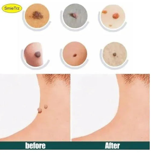 Skin Tag Remover Gel 72Pcs