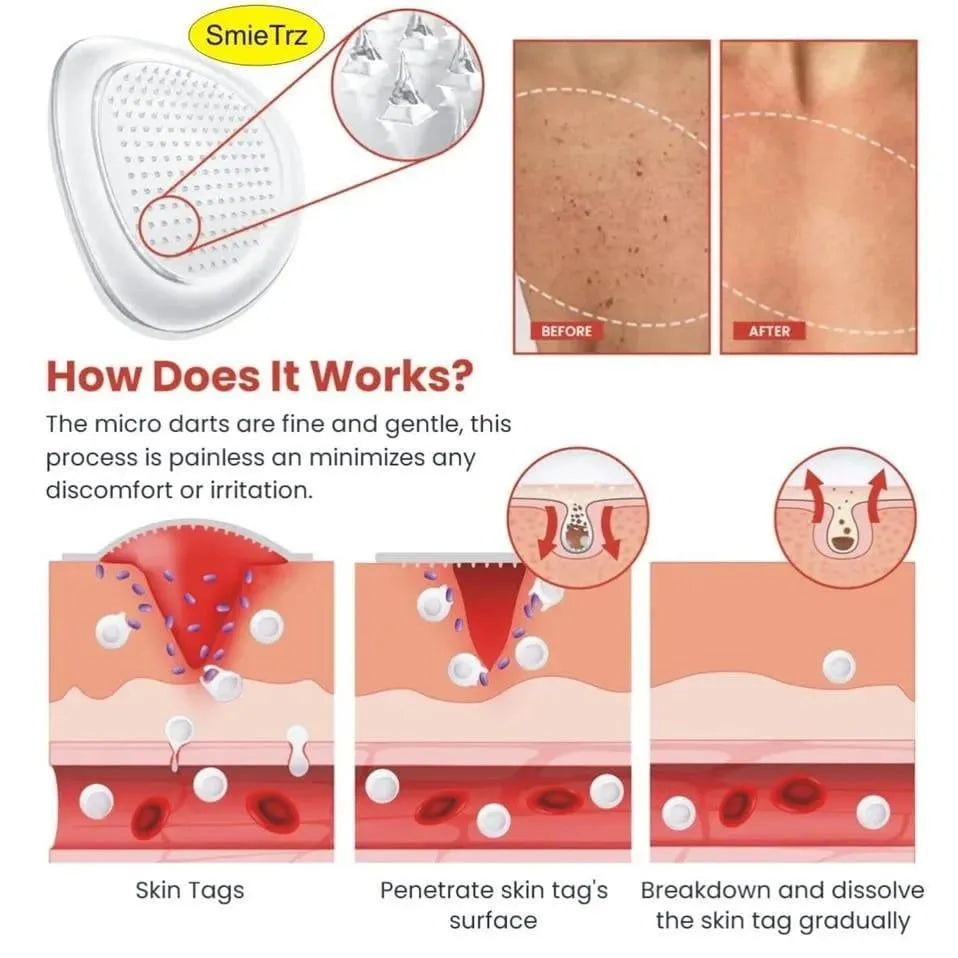 Skin Tag Remover Gel 72Pcs
